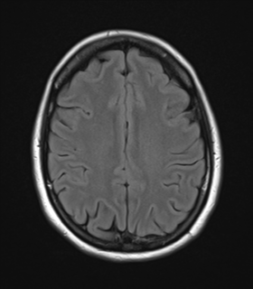 File:Cavernoma with bleed - midbrain (Radiopaedia 54546-60774 Axial FLAIR 22).png