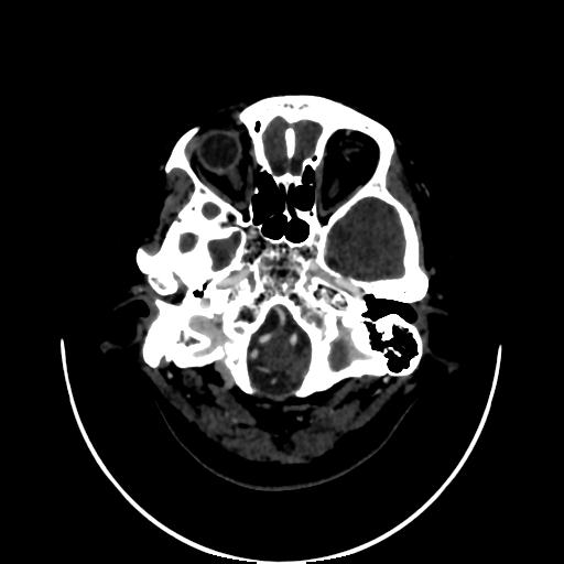 File:Cavernoma with developmental venous anomaly (Radiopaedia 22470-22506 C 12).jpg