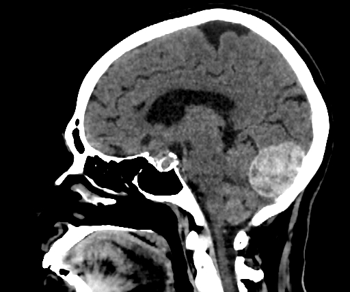 Cavernous hemangioma of the cerebellar falx (Radiopaedia 73025-83723 B 151).jpg