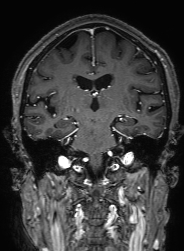 Cavernous hemangioma of the cerebellar falx (Radiopaedia 73025-83724 Coronal T1 C+ 207).jpg