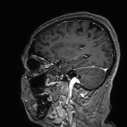 File:Cavernous hemangioma of the cerebellar falx (Radiopaedia 73025-83724 Sagittal T1 C+ 60).jpg