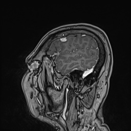 Cavernous sinus meningioma (Radiopaedia 63682-72367 Sagittal T1 C+ 41).jpg