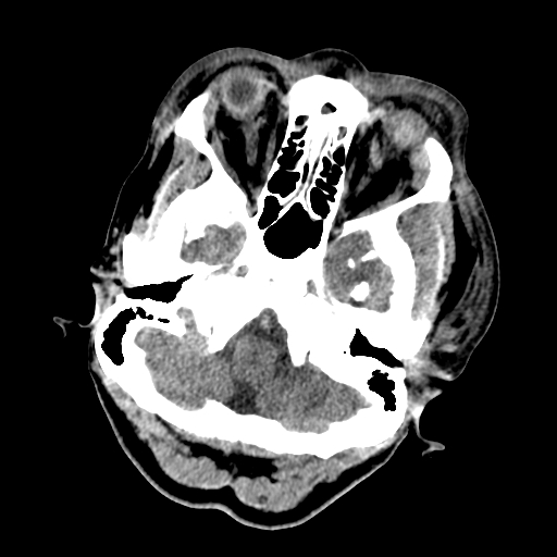 File:Cavernous sinus thrombosis (Radiopaedia 10619-11078 Axial non-contrast 7).jpg