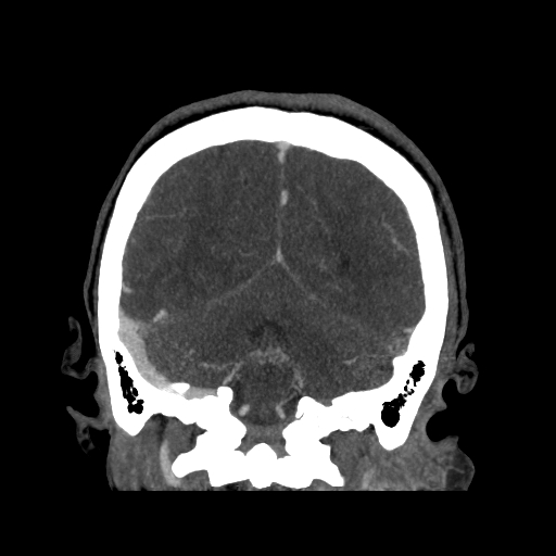 File:Cavernous sinus thrombosis (Radiopaedia 10619-11078 D 24).jpg