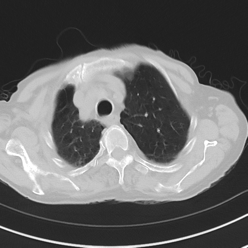 Cavitating pneumonia - lingular segments (Radiopaedia 34386-35678 Axial lung window 14).png