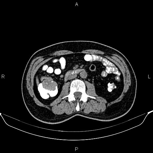 Cecal adenocarcinoma (Radiopaedia 85324-100916 Axial non-contrast 46).jpg