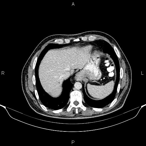 Cecal adenocarcinoma (Radiopaedia 85324-100916 B 11).jpg