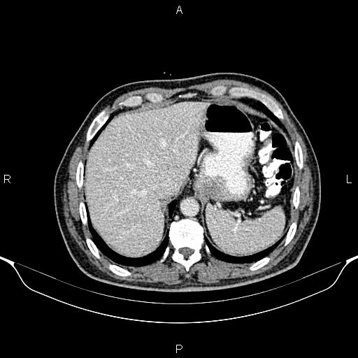 Cecal adenocarcinoma (Radiopaedia 85324-100916 B 15).jpg
