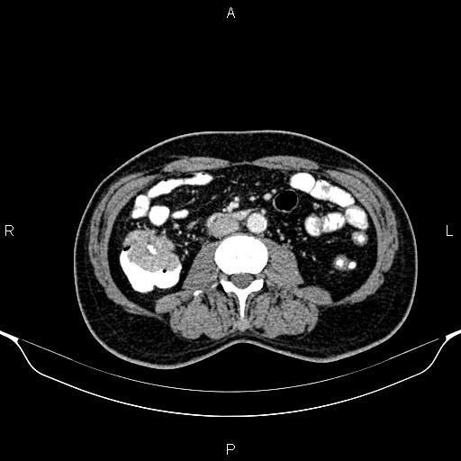 Cecal adenocarcinoma (Radiopaedia 85324-100916 B 49).jpg