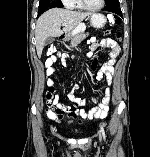 Cecal adenocarcinoma (Radiopaedia 85324-100916 D 19).jpg