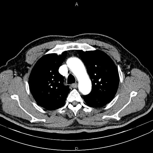 File:Cecal cancer with appendiceal mucocele (Radiopaedia 91080-108651 A 22).jpg