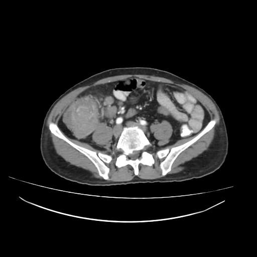 Cecal carcinoma with local lymphadenopathy (Radiopaedia 31428-32240 A 34).jpg