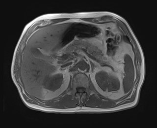 Cecal mass causing appendicitis (Radiopaedia 59207-66532 Axial T1 in-phase 45).jpg