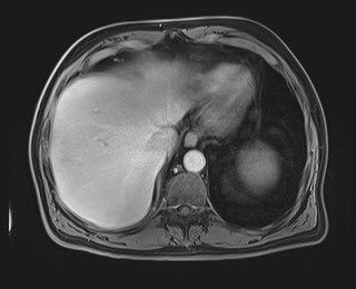 Cecal mass causing appendicitis (Radiopaedia 59207-66532 J 28).jpg