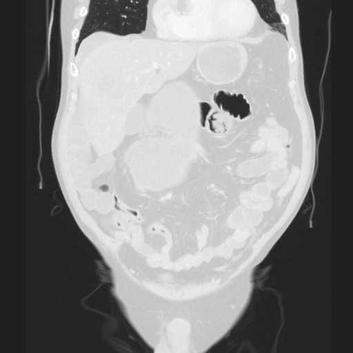 Cecal volvulus (Radiopaedia 75378-86620 Coronal lung window 55).jpg