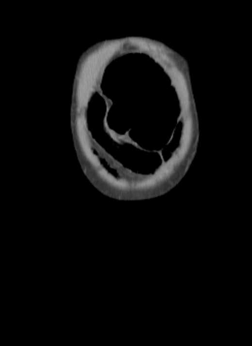 Cecal volvulus with pneumatosis coli (Radiopaedia 68572-78178 B 71).jpg