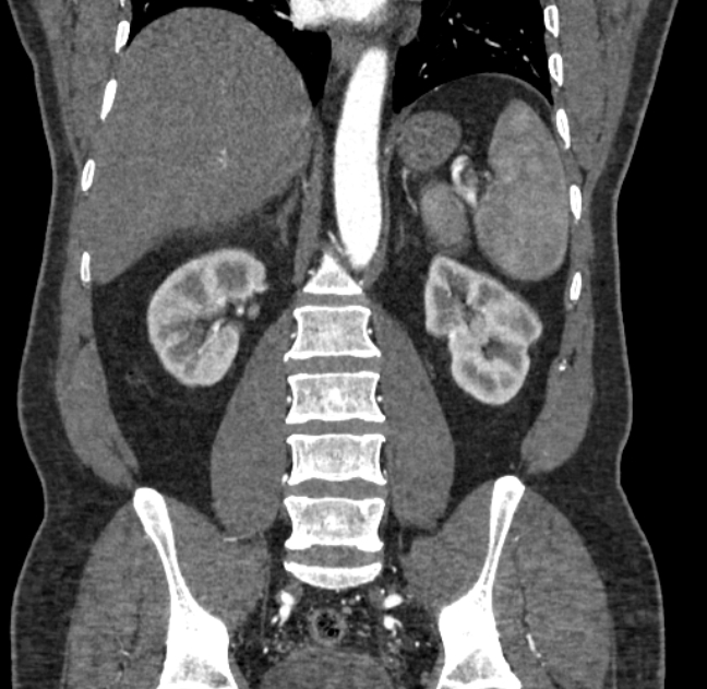Celiac artery dissection (Radiopaedia 52194-58080 C 96).jpg