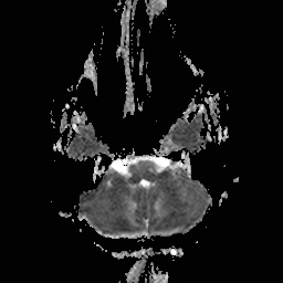 File:Central-variant posterior reversible encephalopathy syndrome (PRES) (Radiopaedia 43880-47358 Axial ADC 4).jpg