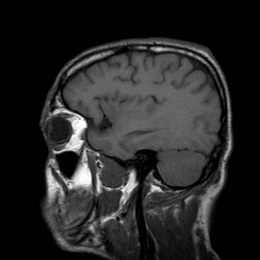 File:Central-variant posterior reversible encephalopathy syndrome (PRES) (Radiopaedia 43880-47358 Sagittal T1 5).jpg