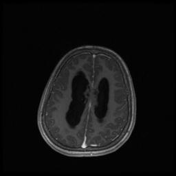 Central neurocytoma (Radiopaedia 30220-30842 Axial T1 C+ 109).jpg