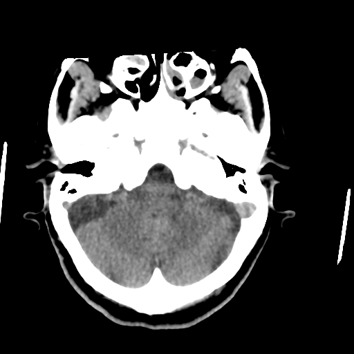 Central neurocytoma (Radiopaedia 65317-74346 Axial non-contrast 11).png
