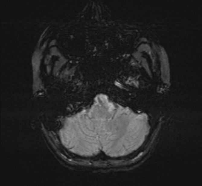 Central neurocytoma (Radiopaedia 70263-80336 Axial SWI 7).jpg