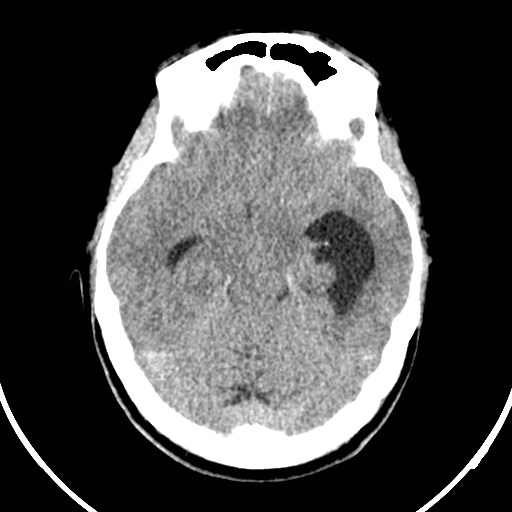 File:Central neurocytoma (Radiopaedia 84497-99871 Axial non-contrast 17).jpg