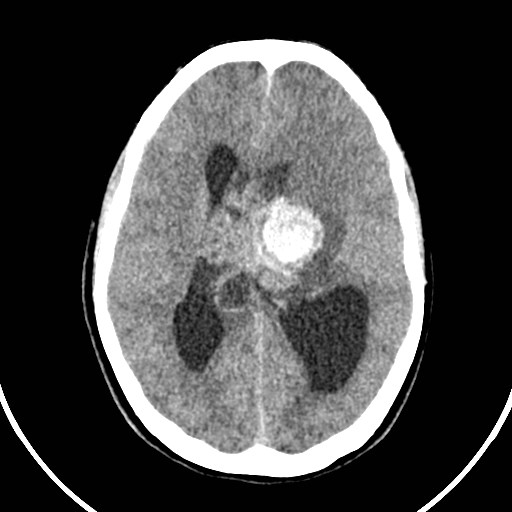 File:Central neurocytoma (Radiopaedia 84497-99871 Axial non-contrast 29).jpg