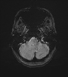 Central neurocytoma (Radiopaedia 84497-99872 Axial SWI 10).jpg
