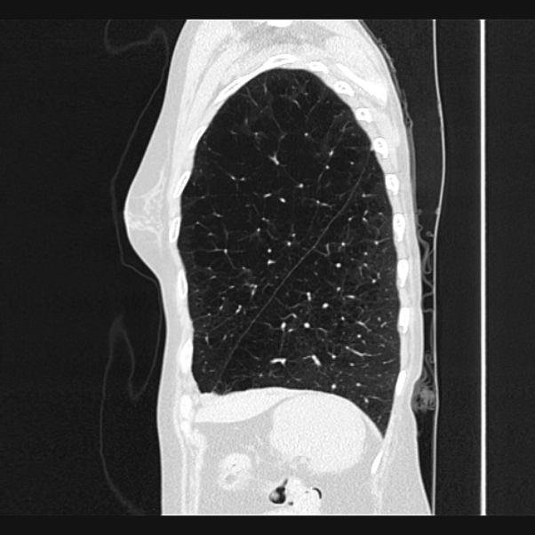 Centrilobular pulmonary emphysema (Radiopaedia 24495-24789 Sagittal lung window 71).jpg
