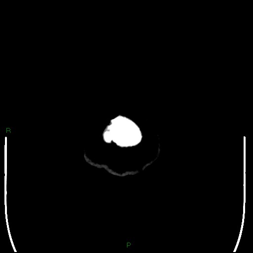 Cerebellar abscess (Radiopaedia 78135-90671 Axial non-contrast 118).jpg