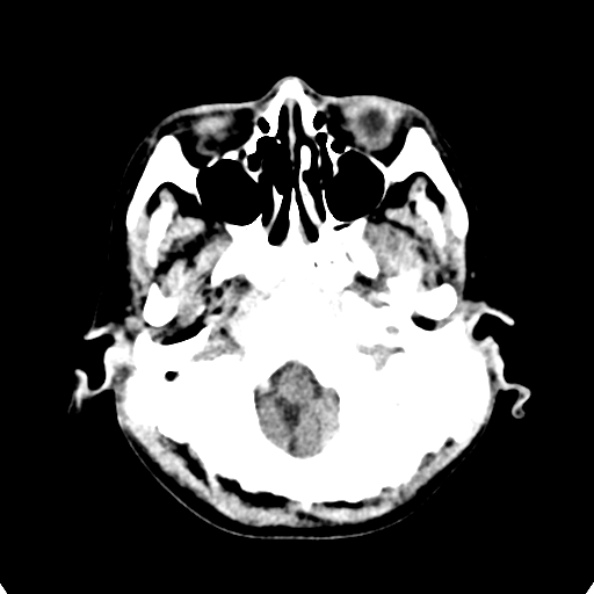 File:Cerebellar abscess secondary to mastoiditis (Radiopaedia 26284-26412 Axial non-contrast 17).jpg