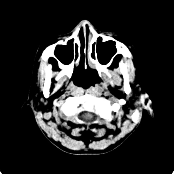 File:Cerebellar abscess secondary to mastoiditis (Radiopaedia 26284-26412 Axial non-contrast 5).jpg