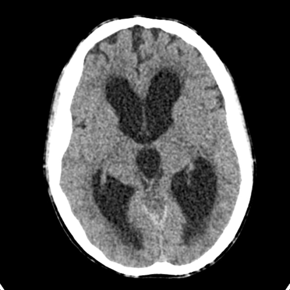 File:Cerebellar abscess secondary to mastoiditis (Radiopaedia 26284-26412 Axial non-contrast 76).jpg