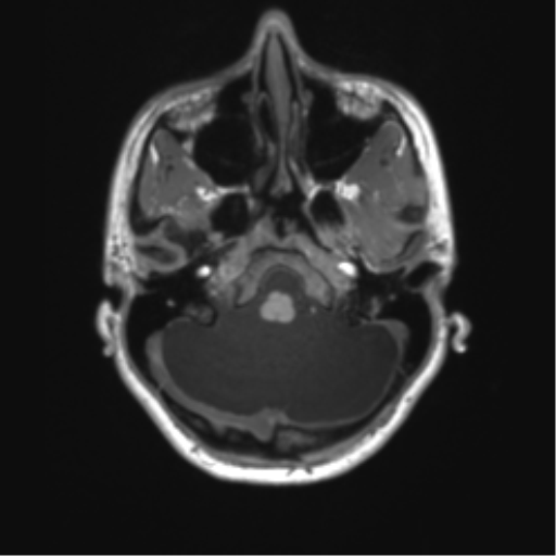 Cerebellar agenesis with hypoplastic pons (pontocerebellar hypoplasia) (Radiopaedia 57224-64138 Axial T1 18).png