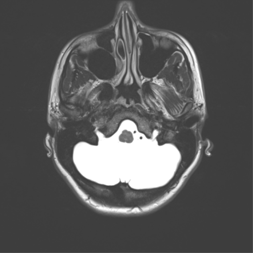 File:Cerebellar agenesis with hypoplastic pons (pontocerebellar hypoplasia) (Radiopaedia 57224-64138 Axial T2 9).png