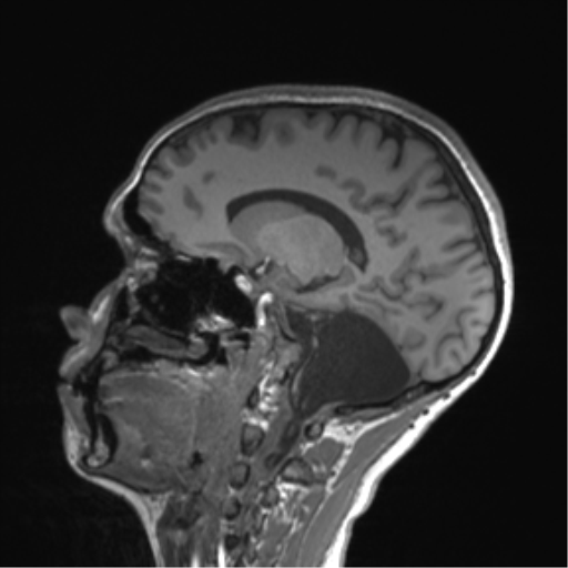 Cerebellar agenesis with hypoplastic pons (pontocerebellar hypoplasia) (Radiopaedia 57224-64138 Sagittal T1 31).png