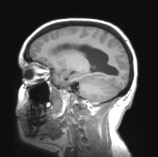 File:Cerebellar ependymoma complicated by post-operative subdural hematoma (Radiopaedia 83322-97736 Sagittal T1 15).png