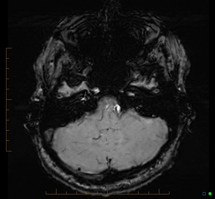 Cerebellar gangliocytoma (Radiopaedia 65377-74422 Axial SWI 12).jpg