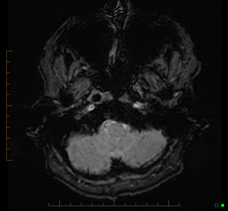 Cerebellar gangliocytoma (Radiopaedia 65377-74422 Axial SWI 5).jpg