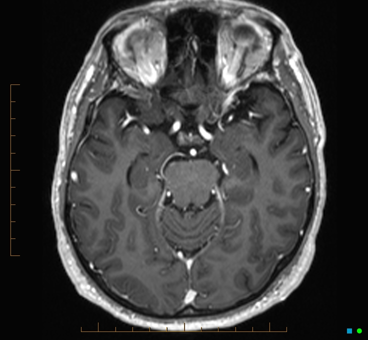 Cerebellar gangliocytoma (Radiopaedia 65377-74422 Axial T1 C+ 47).jpg