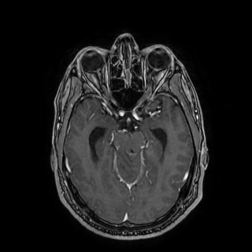 Cerebellar hemangioblastoma (Radiopaedia 88055-104622 Axial T1 C+ 78).jpg