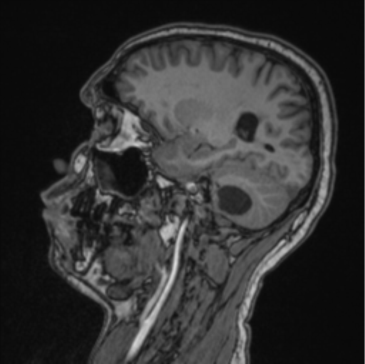 Cerebellar hemangioblastomas and pituitary adenoma (Radiopaedia 85490-101176 Sagittal T1 64).png