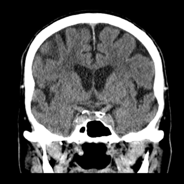 Cerebellar hemorrhage (Radiopaedia 27193-27359 Coronal non-contrast 26).jpg