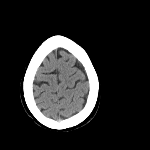 File:Cerebellar infarct due to vertebral artery dissection with posterior fossa decompression (Radiopaedia 82779-97029 Axial non-contrast 25).png