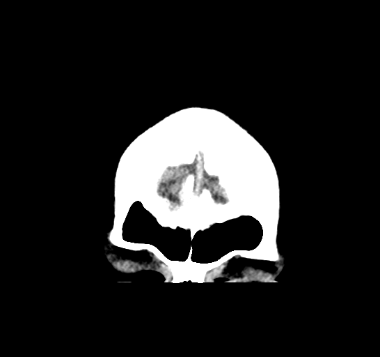 File:Cerebellar infarct due to vertebral artery dissection with posterior fossa decompression (Radiopaedia 82779-97031 Coronal non-contrast 6).png