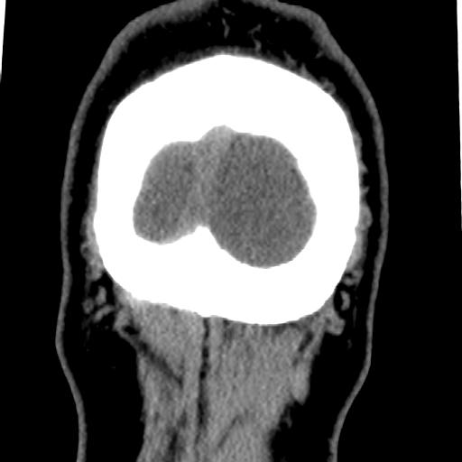 Cerebellar infarction (Radiopaedia 16625-16327 Coronal non-contrast 47).jpg