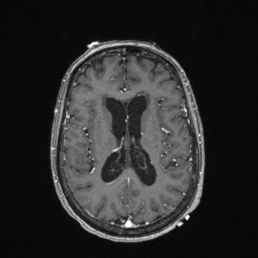 Cerebellar metastases (Radiopaedia 24038-24249 Axial T1 C+ 8).jpg