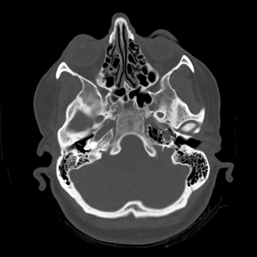 Cerebellar metastasis (cystic appearance) (Radiopaedia 41395-44258 Axial bone window 12).png