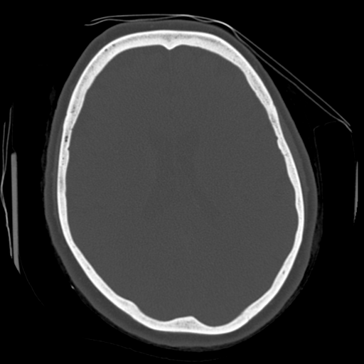 Cerebellar metastasis (cystic appearance) (Radiopaedia 41395-44258 Axial bone window 41).png